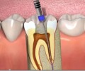 Как пломбируют каналы в зубе